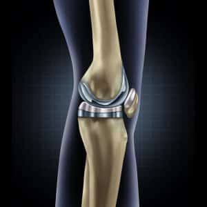 dupuy-Attune-knee-problems-omaha-attorney