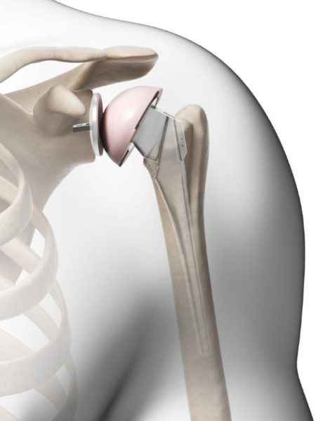 Zimmer Biomet Class Recall of Shoulder Replacement Systems