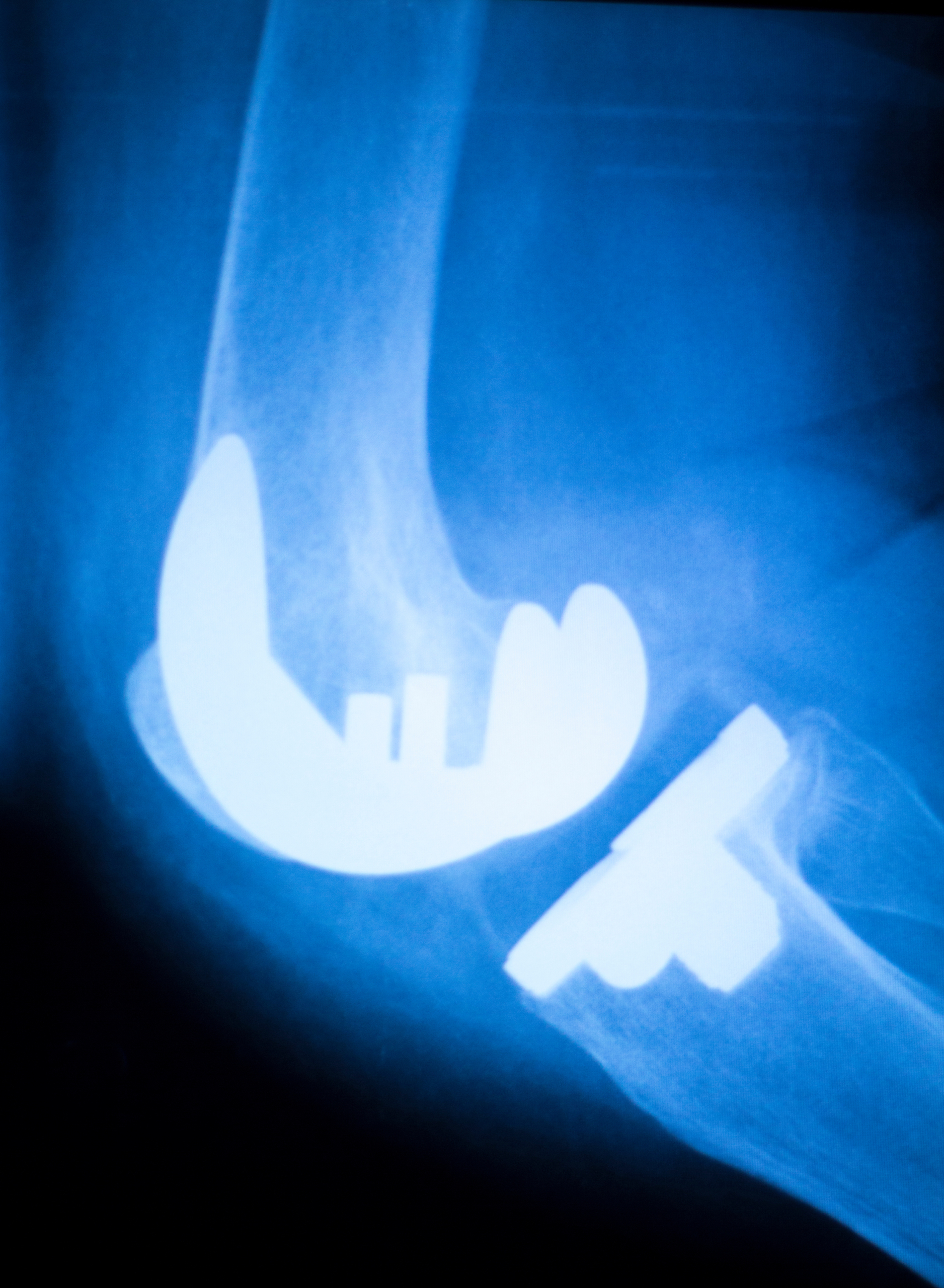 Exactech Hip, Knee and Ankle Implant Lawsuits